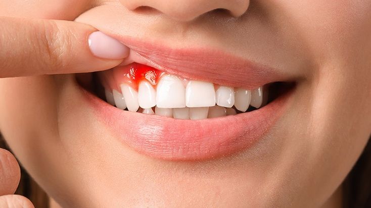 Bleeding Gums Aren't Normal